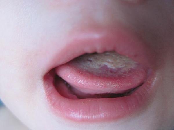 疾病科普:何为口炎,该病有哪些症状?